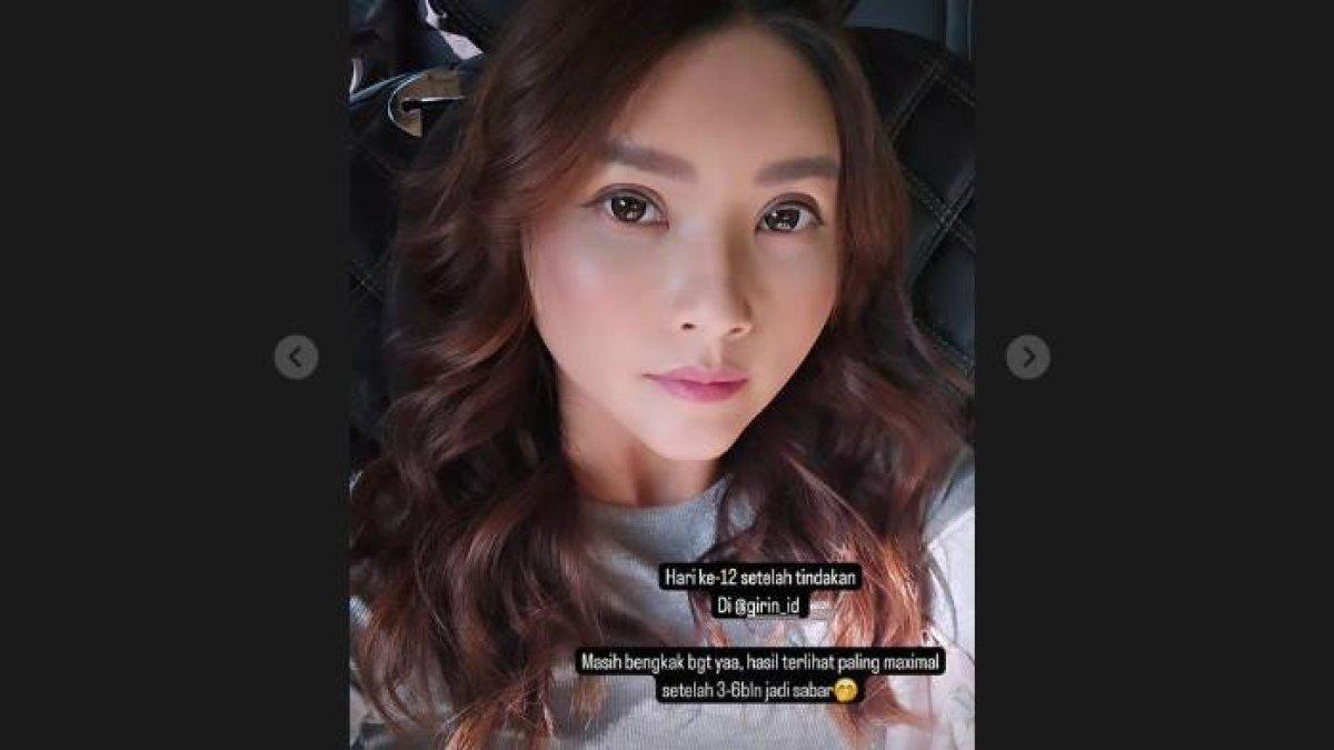 Penampakan terbaru Sarwendah setelah operasi plastik di Korea