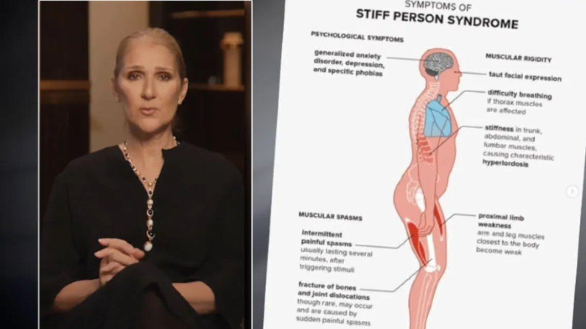 Penyakit langka yang diderita Celine Dion belum ditemukan obatnya