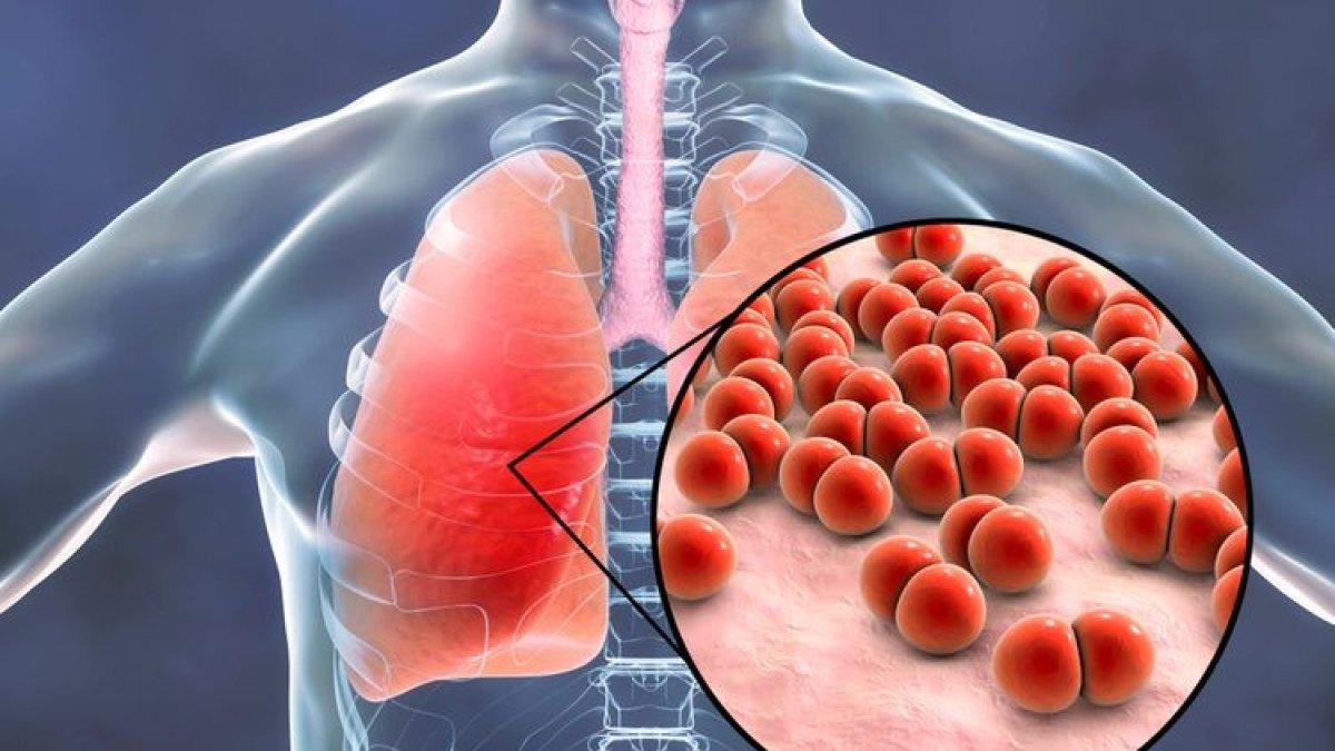 Pneumonia terdiri dari empat tahap perkembangan infeksi, yaitu kongesti, hepatisasi merah, hepatisasi abu-abu, dan resolusi.