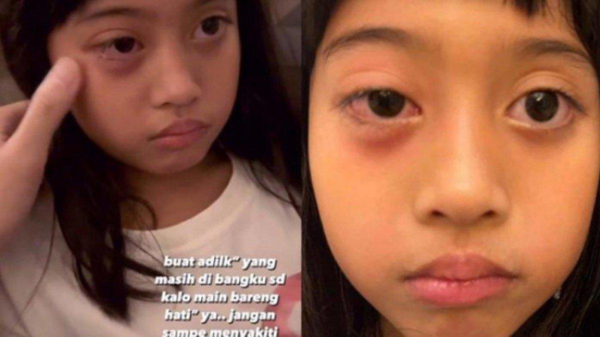Sempat tak mengeluh sakit, namun malam harinya putri Venna mengeluh matanya terus berair hingga bengkak.