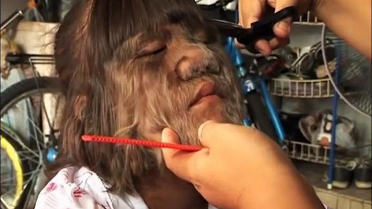 Rambut Supatra menutupi hampir seluruh tubuhnya, bahkan para dokter di Thailand belum pernah melihat kasus seperti ini.