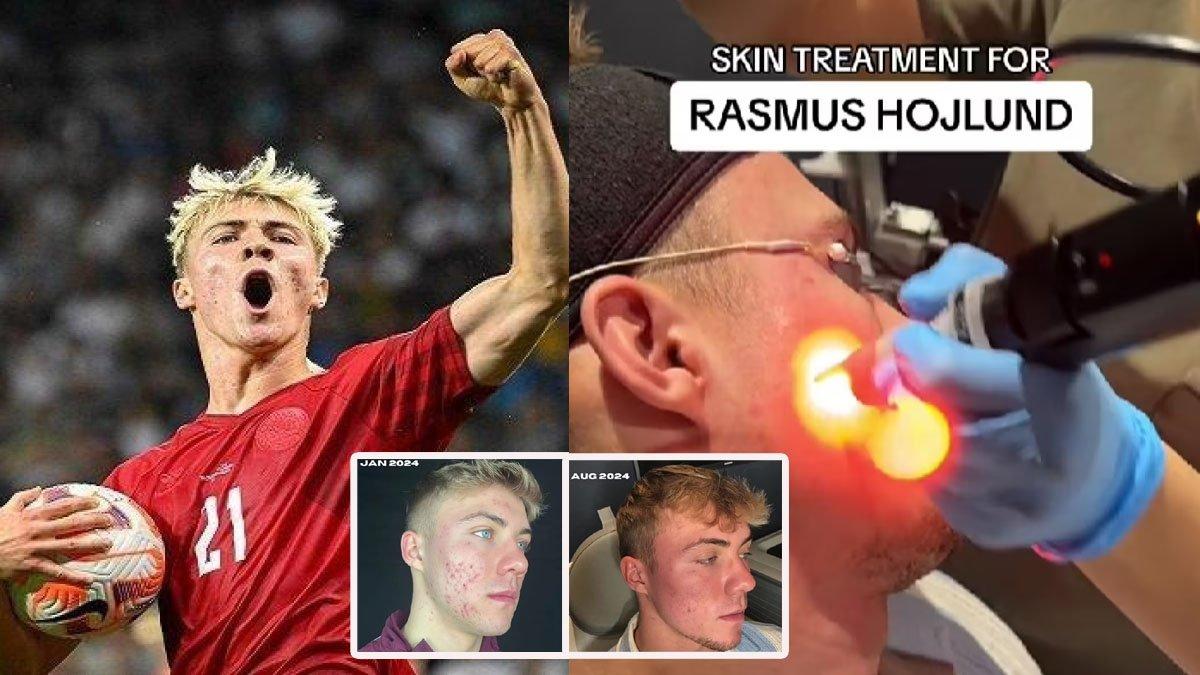 Rasmus Hojlund lakukan laser jerawat
