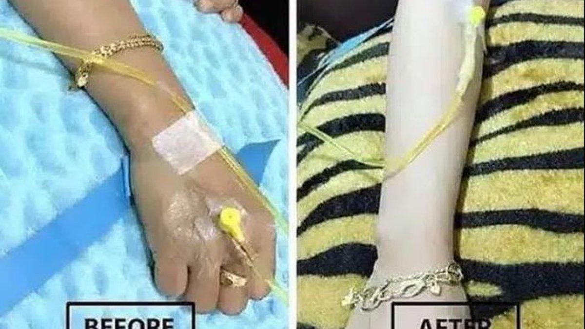 Rutin Infus Whitening Wanita Muda Ini Jadi Pasien Autoimune