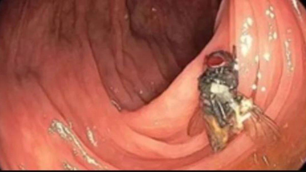 Seekor lalat di dalam usus seorang pria selama kolonoskopi.