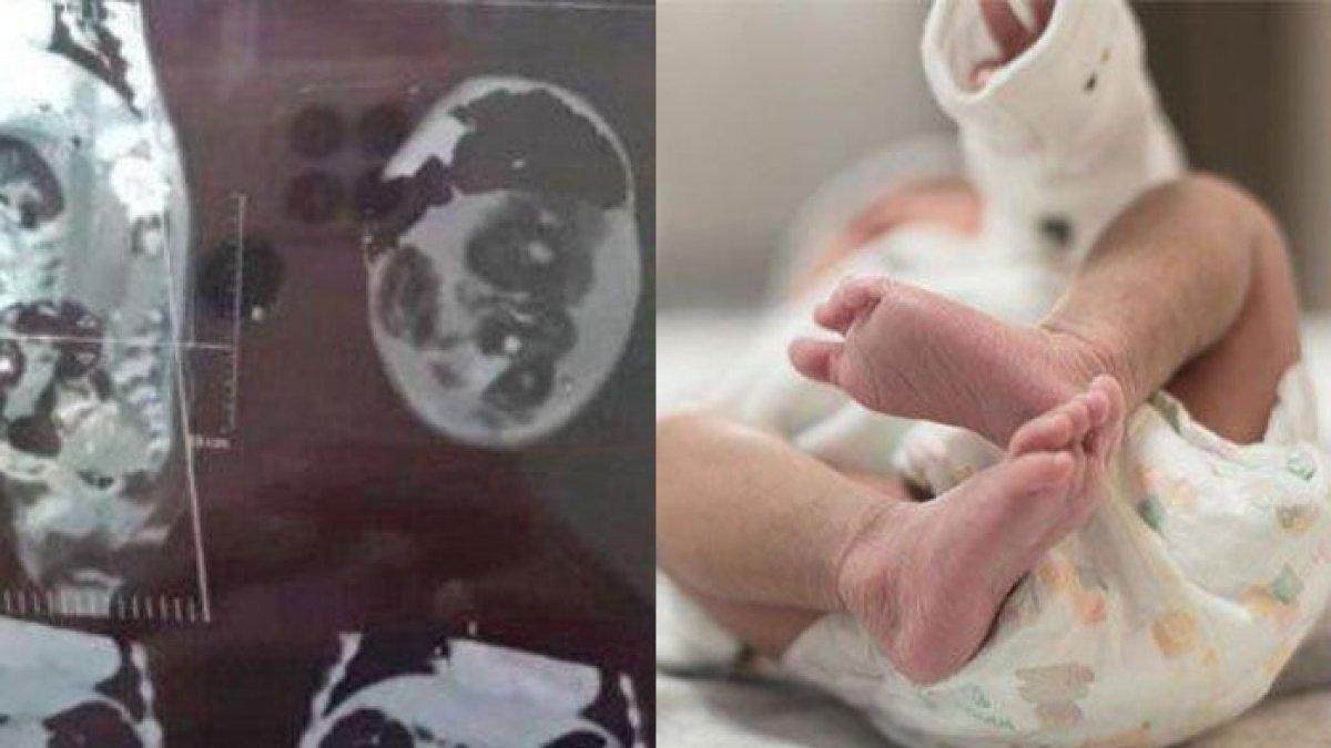 Sempat dikabarkan, bayi di Padang perutnya membesar, orang tua menduga bayinya hamil