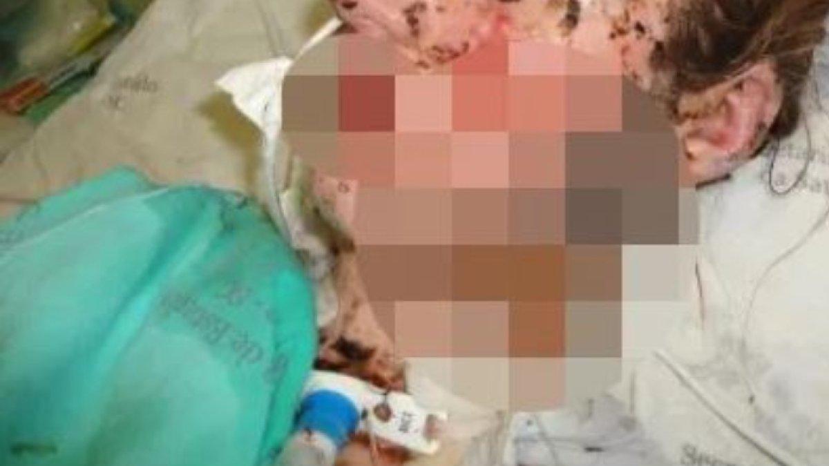 Jaqueline menderita Sindrom Stevens-Johnson, yaitu suatu kondisi yang sangat langka yang disebabkan oleh reaksi berlebihan tubuh terhadap obat-obatan.