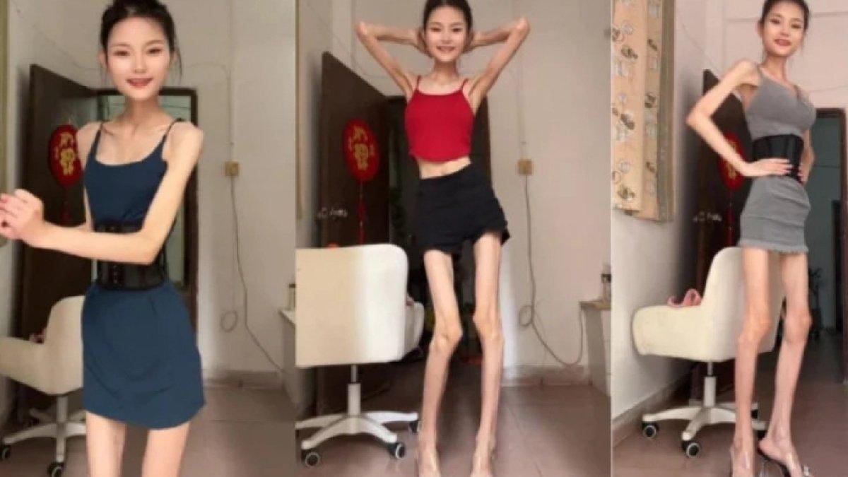 Sosok Baby Tingzi influencer asal China dengan berat badan 25 kg, sering disebut kerangka berjalan.