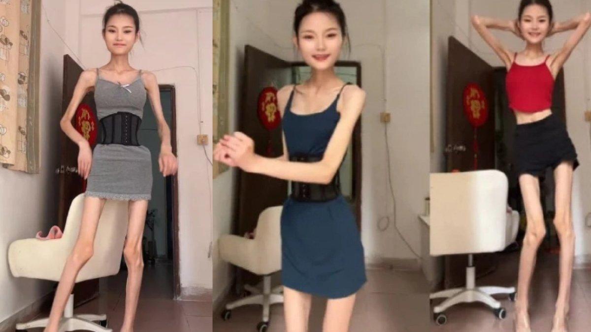 Sosok Baby Tingzi influencer asal China dengan berat badan 25 kg, sering disebut kerangka berjalan.