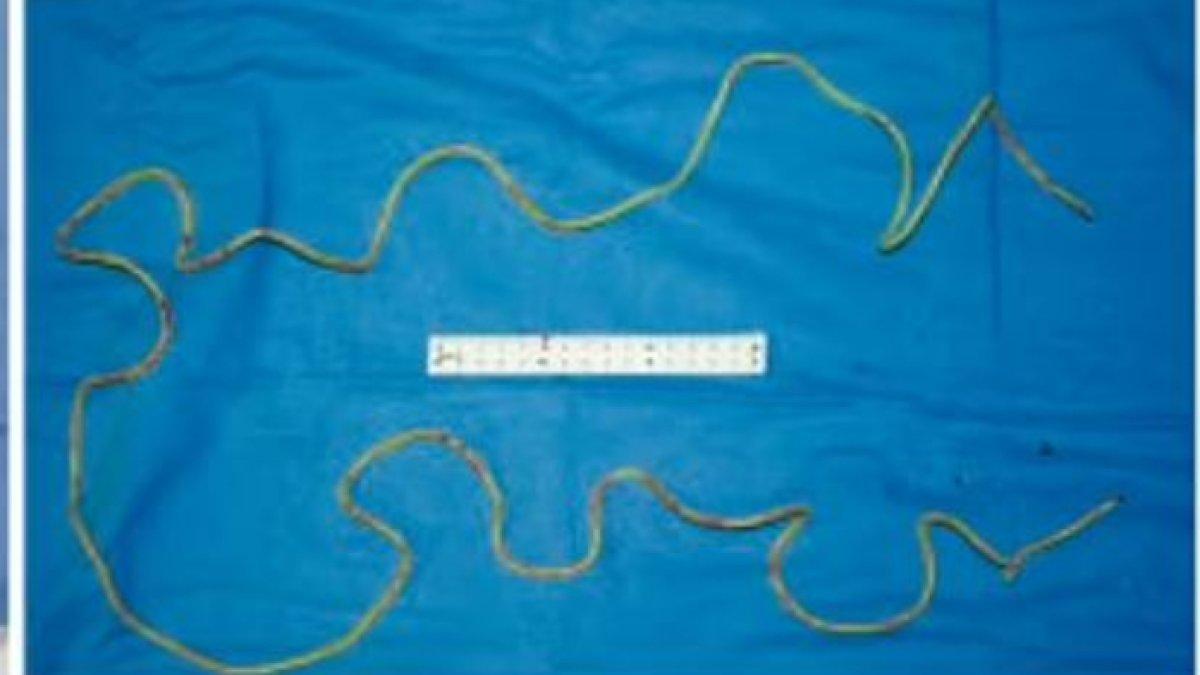 Lompat tali sepanjang 230cm setelah petugas medis melakukan operasi mengeluarkan benda tersebut dari kandung kemihnya