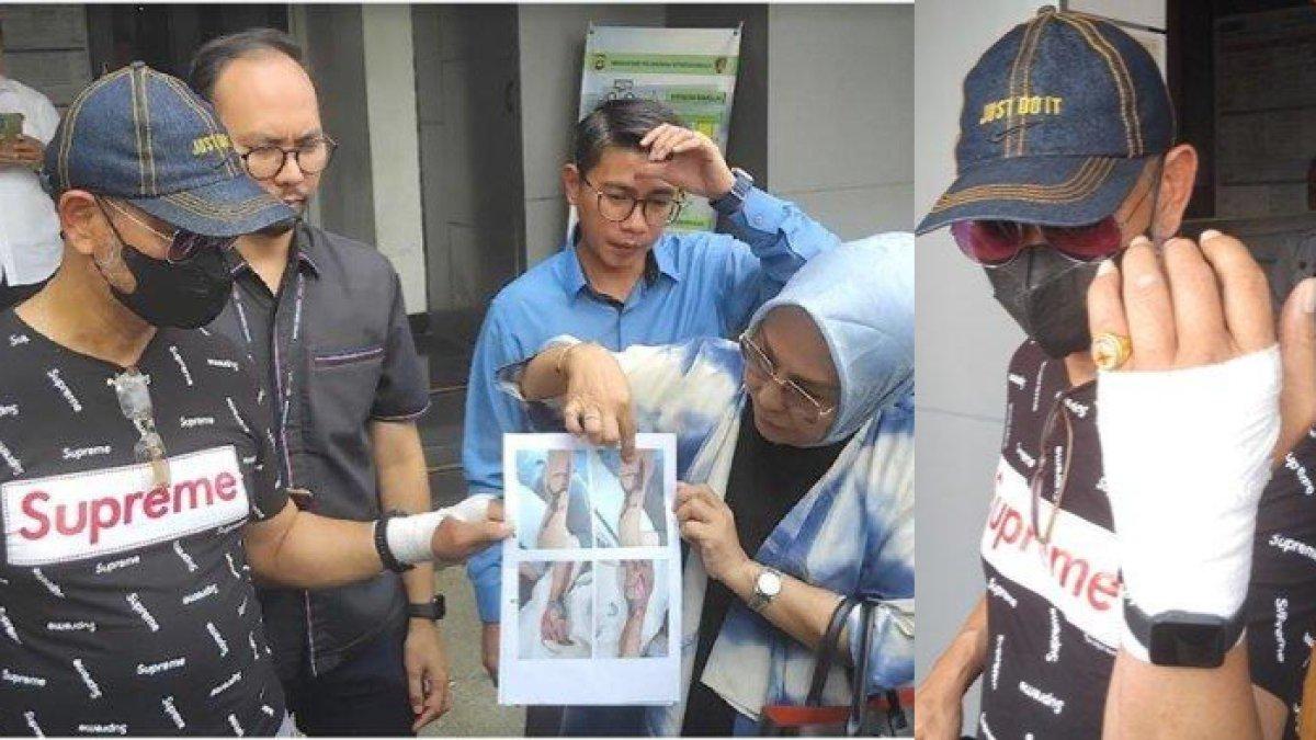 Tangan membusuk usai infus diare, Petrus (58) seorang pasien melaporkan dugaan kasus malapraktik yang terjadi salah satu rumah sakit di Palembang ke Polda Sumsel. Kuasa hukum mendampingi korban dugaan malpraktik ketika datang ke Polda Sumsel, Rabu (10/1/2024).