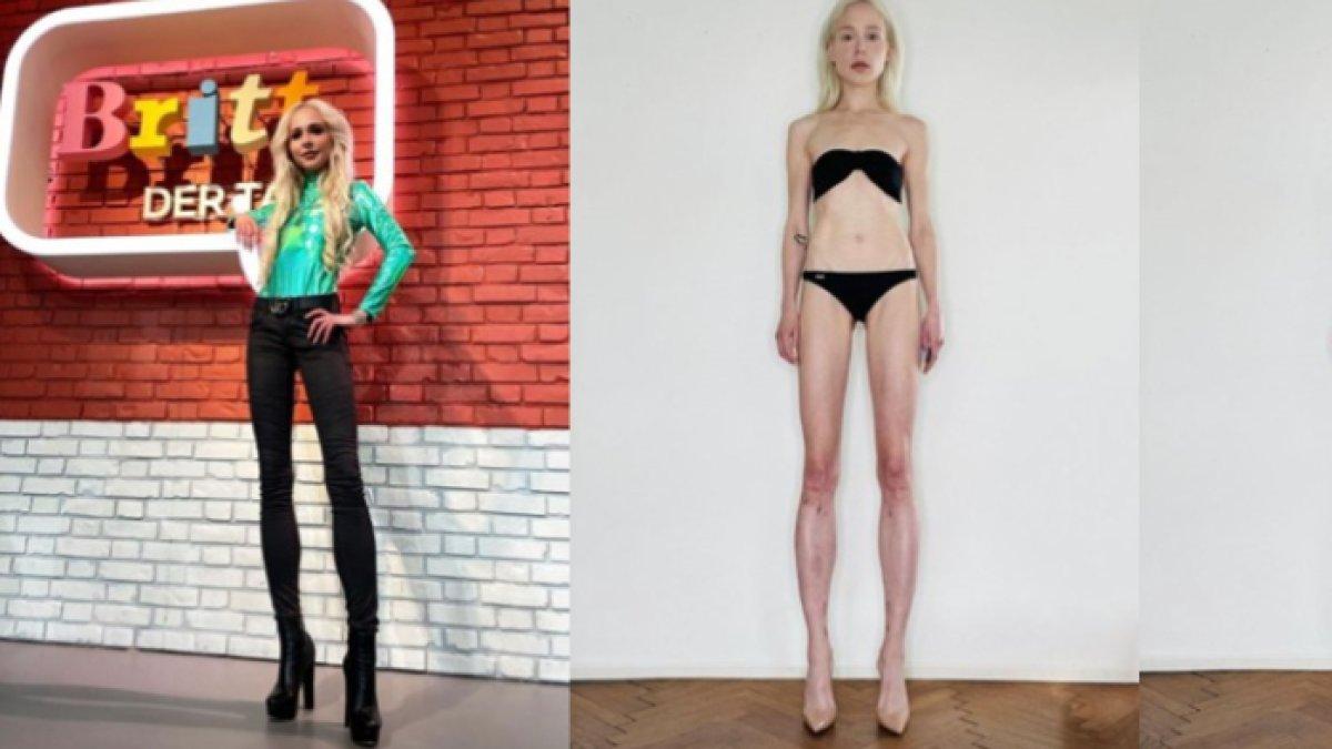 Theresia menjalani operasi untuk menambah tinggi badannya sebesar 14 cm, dari 1,67m menjadi 1,81m.