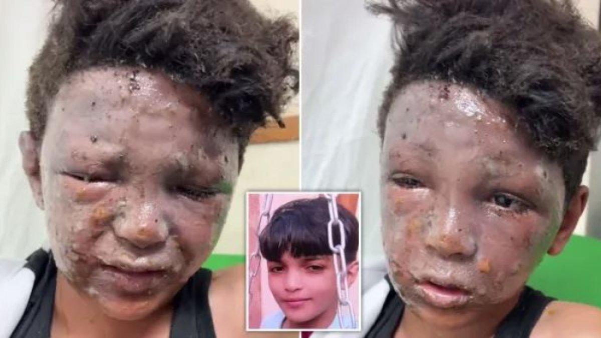 Wajah Ali terlihat melepuh karena terbakar dan luka-luka.