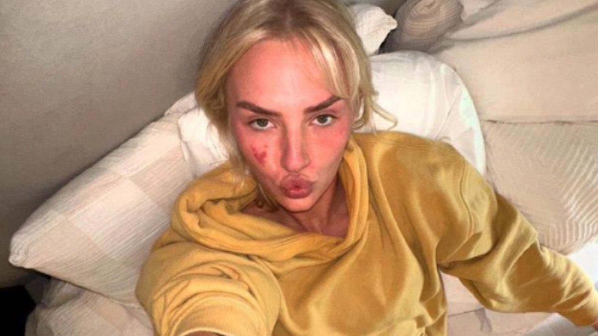 Wanita dengan tompel jumbo di wajah, kini jadi influencer, dulu dibully kini bangga