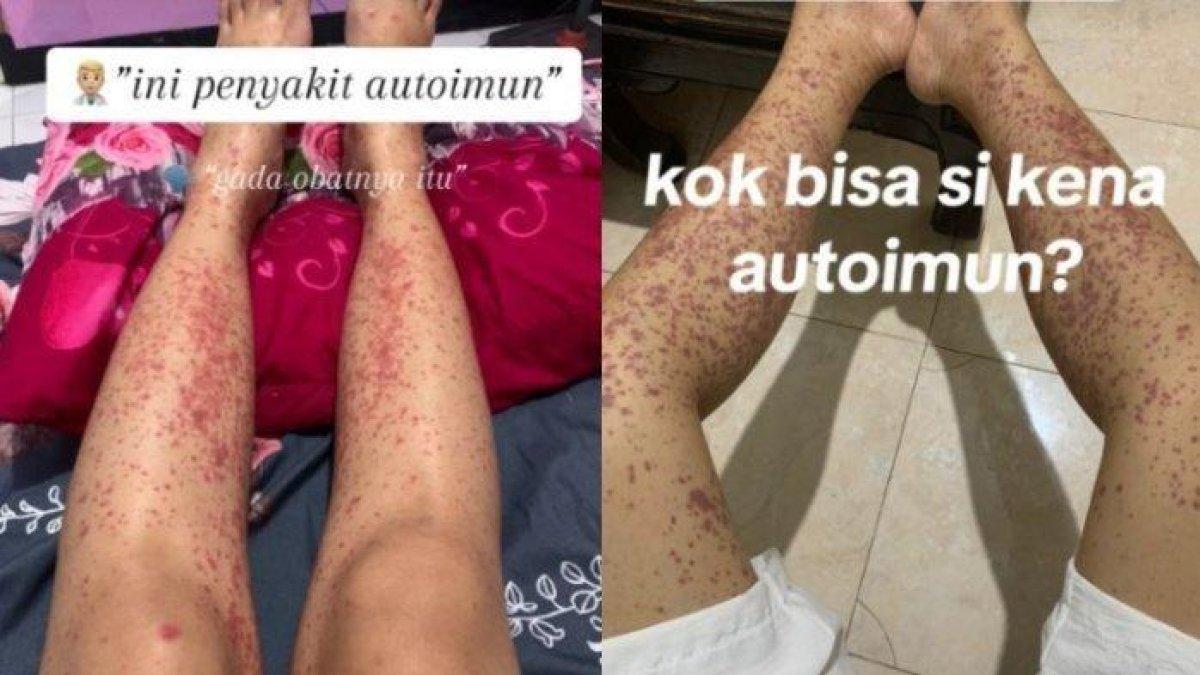 Wanita muda di Sidoarjo divonis autoimun gegara makan sembarangan, sering jajan