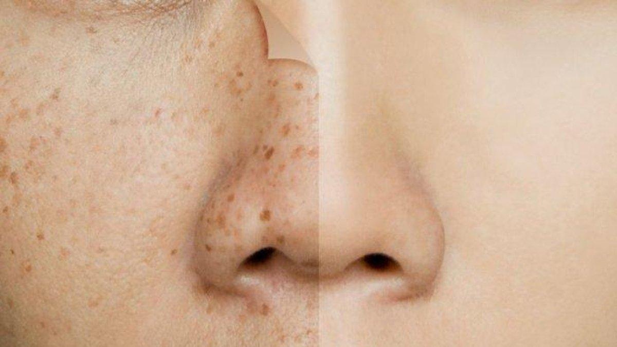 ILUSTRASI wajah bermasalah gegara kosmetik ilegal