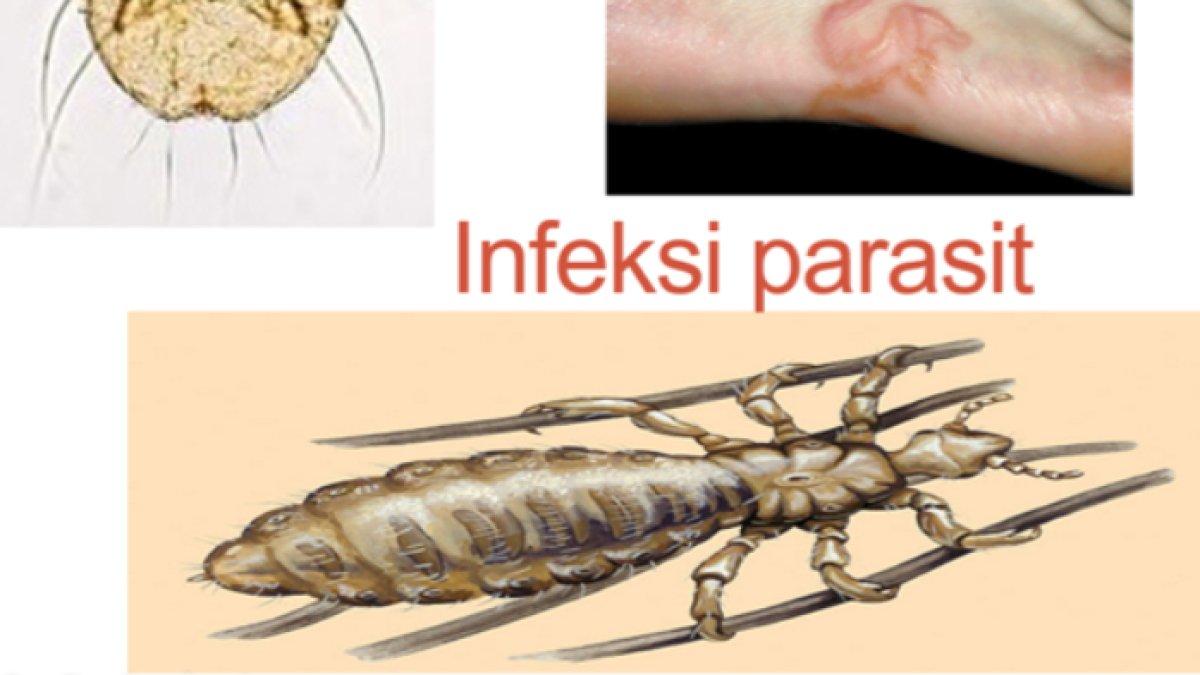 Infeksi kutu parasit