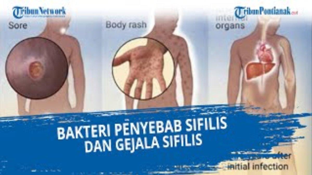 kunci jawaban terbaik dari pertanyaan 'Apa nama bakteri penyebab penyakit sifilis? Jelaskan!