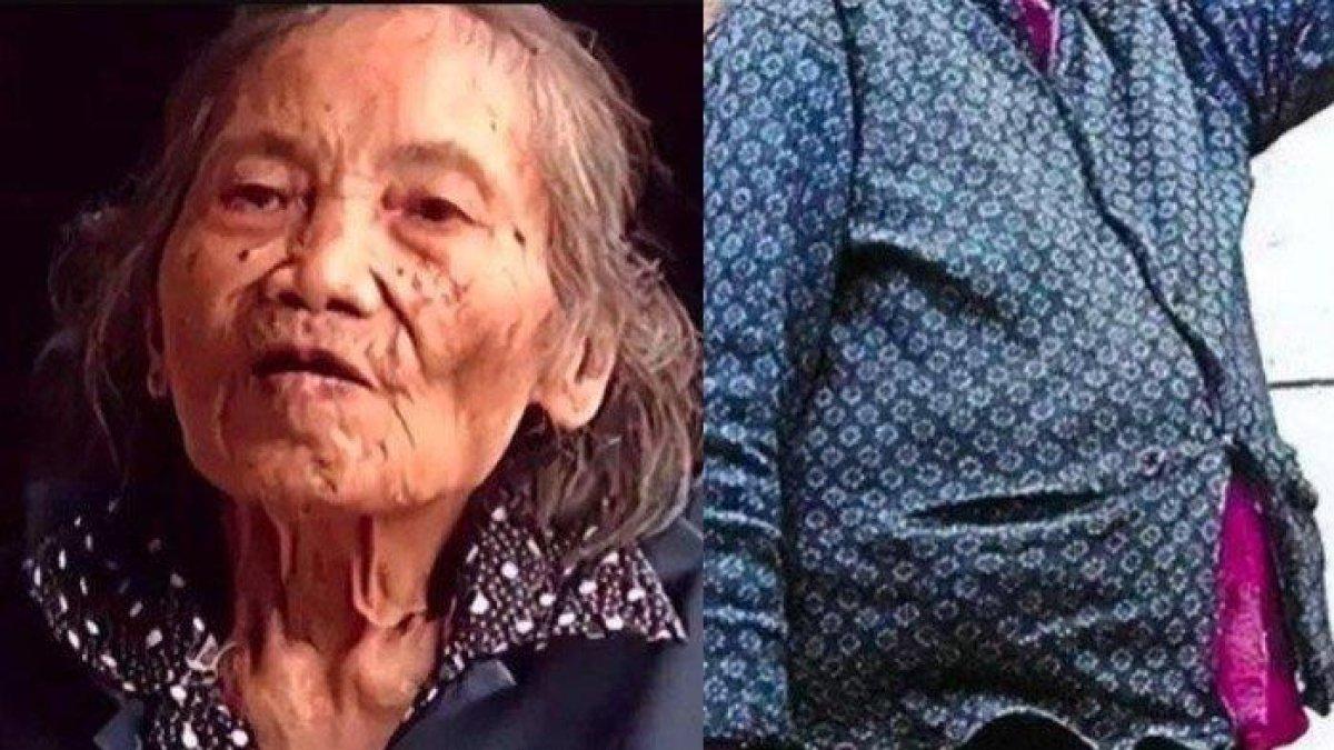 Sosok nenek berusia 91 tahun ini telah 40 tahun menyimpan mayat janinnya di dalam kandungannya, tak punya uang untuk operasi