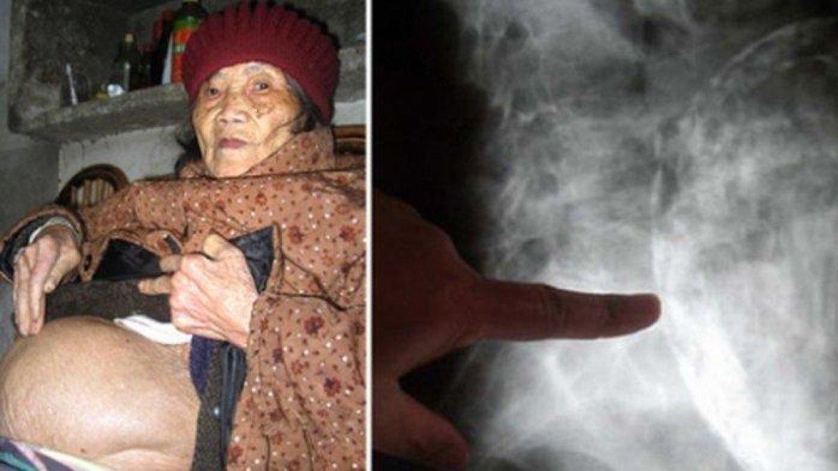 Sosok nenek berusia 91 tahun ini telah 40 tahun menyimpan mayat janinnya di dalam kandungannya, tak punya uang untuk operasi
