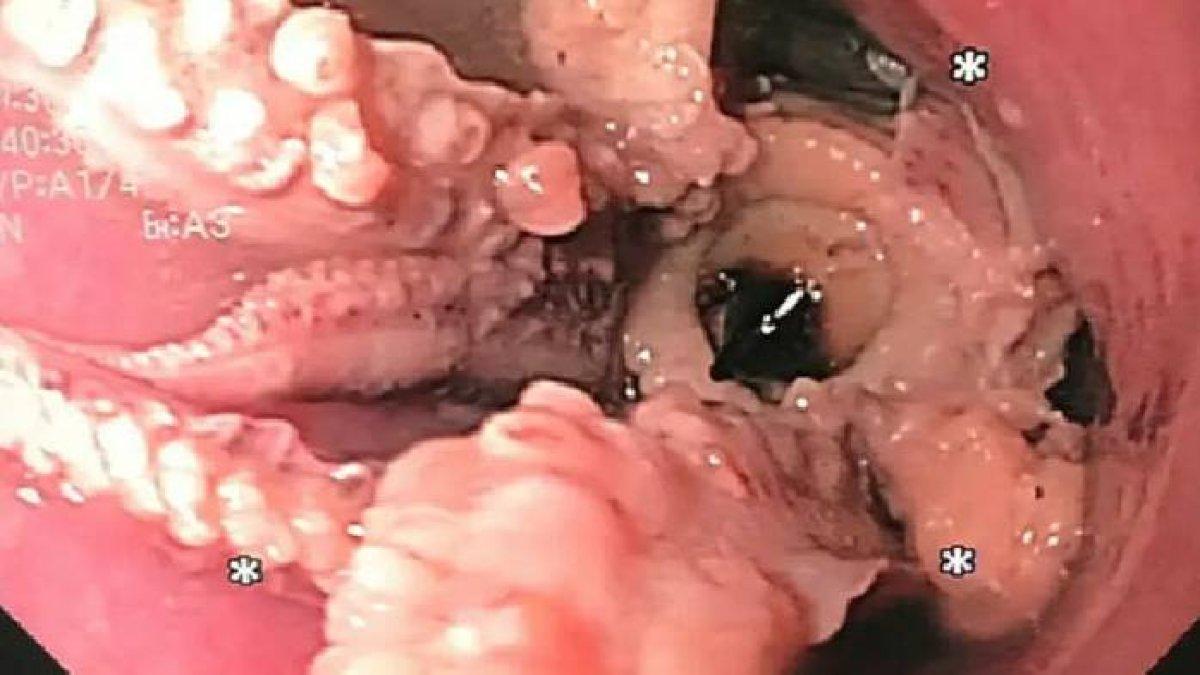 Pasien mengeluh sulit menelan, saat ditelusur di rumah sakit, ternyata ada hewan ini 2