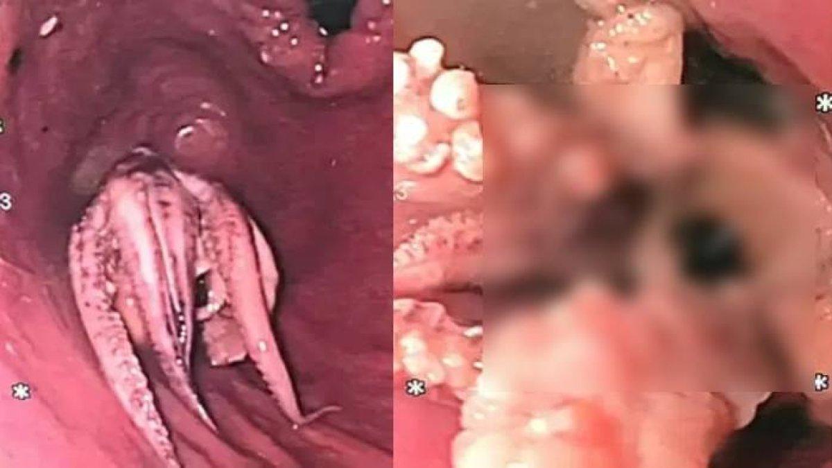 Pasien mengeluh sulit menelan, saat ditelusur di rumah sakit, ternyata ada hewan ini