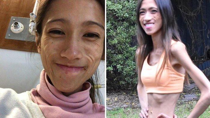 Sarah Rav Photo Terobsesi Kurus, Dokter Idap Anoreksia dan Hampir Tewas, Penampilan ...