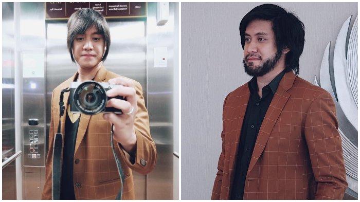 Perubahan Kevin Aprilio setelah jalani transplantasi rambut