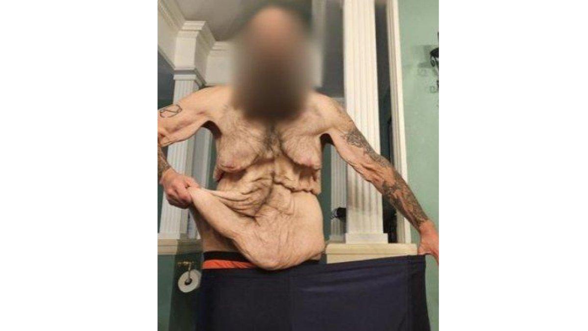 Pria obesitas yang berhasil menurunkan berat badan lebih dari 100 Kg