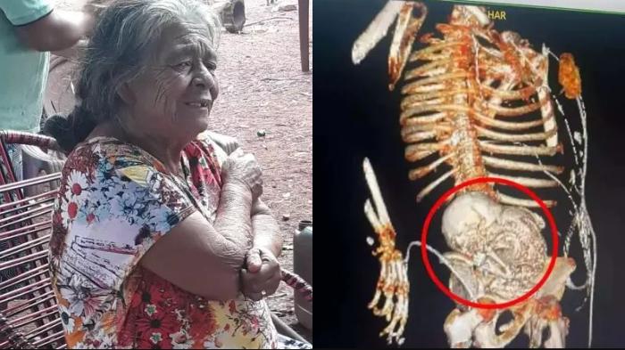 Misteri Medis: Nenek 81 Tahun di Brasil dengan Janin Batu Berusia 56 Tahun