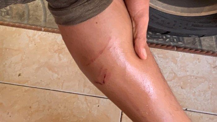 Tangan Farel Kany (17) murid SMAN 15 Padang yang digigit anjing liar, saat ditemui di rumahnya di Pisang, Kecamatan Pauh, Kota Padang, Sumatera Barat (Sumbar), Selasa (26/9/2023).