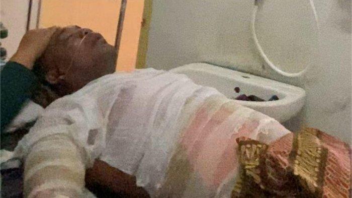 KORBAN KECELAKAAN KERJA- Korban saat dirawat di IGD Rumah Sakit Islam Ibnu Sina Simpang Empat, Selasa (17/6/2025) siang kemarin. Korban terlihat mendapatkan perawatan yang serius dengan selang oksigen terpasang di hidung, sekujur tubuh dibalut dengan kain kasa dan kulitnya melepuh.