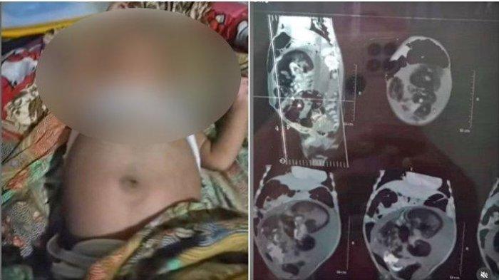 Seorang bayi berusia 5 bulan di Sumbar mengalami pembengkakan perut. Ada dua penyebab dugaan.