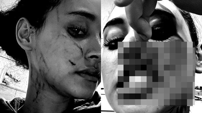 Foto bukti kekerasan fisik yang dialami selebgram Afifah Riyadh dihajar mantan kekasih suaminya.