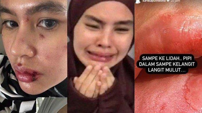 Kartika Putri Sakit Hati Penyakitnya Diejek Hingga Dikaitkan Tahayul