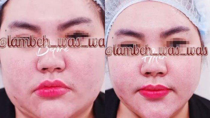 PENAMPILAN LISA MARIANA - Tangkapan layar Instagram Lambe Was Was Selasa (15/4/2025). Lisa Mariana sedot lemak di wajahnya untuk merubah bentuk tubuhnya