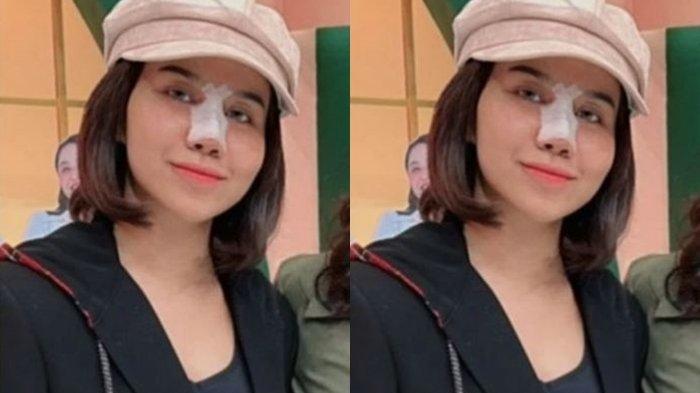 Mayang, adik mendiang Vanessa Angel menyita perhatian setelah melakukan operasi plastik pada hidungnya.