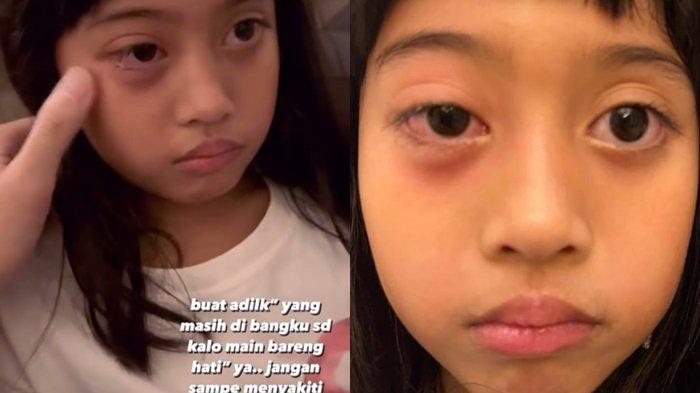 Penampakan wajah Vania Athabina anak Venna Melinda jadi korban bullying.