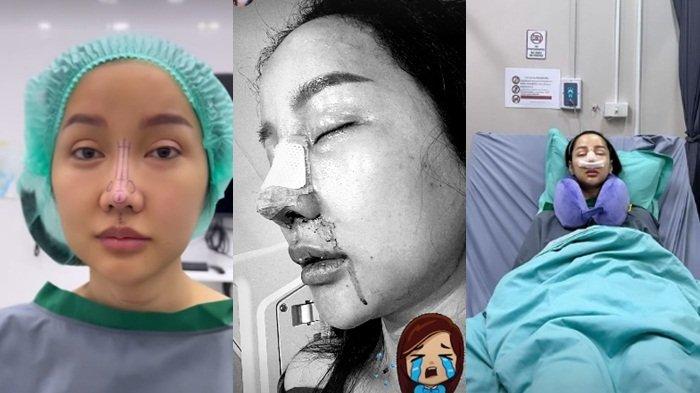 Momen ketika Lucinta Luna melakukan operasi hidung karena ingin seperti K-pop Idol.