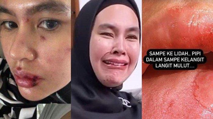 Terjawab Penyakit yang Diderita Kartika Putri hingga Lidah Melepuh