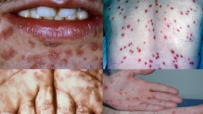 Begini Cara Mendiagnosis Penyakit Sifilis, Pengobatan dan Pencegahannya - Sripoku.com