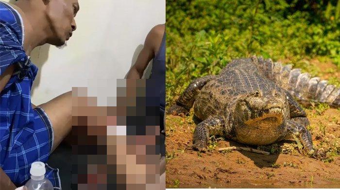 Korban mengalami luka gigitan setelah diserang buaya di Sungai Tapung Desa Batu Gajah Kec Tapung, Kampar Riau, Senin malam (23/9/204).