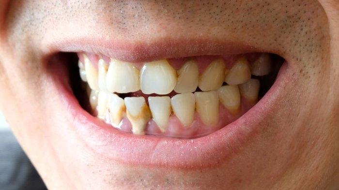 4 Jenis Bahan Dapur yang Bisa Memutihkan Gigi Secara Alami ...