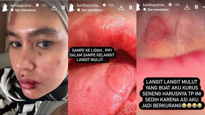 Kartika Putri memperlihatkan dari dekat kondisi di wajahnya tersebut.