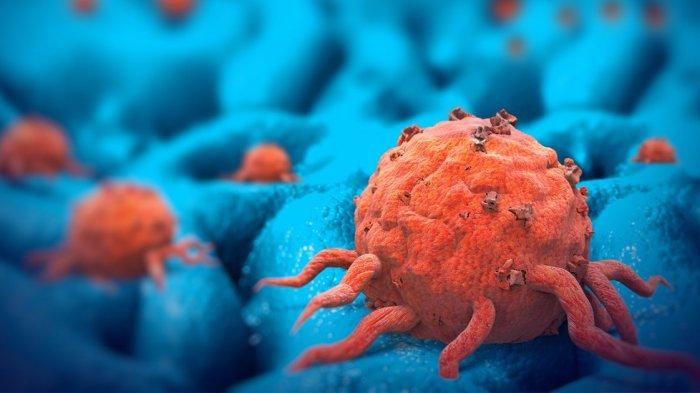 APA Itu Tumor dan Kanker ? Ini Perbedaan Tumor dan Kanker