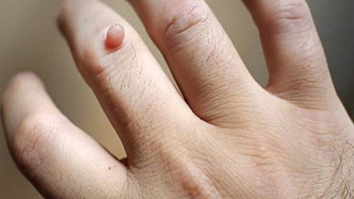 Apa Itu Skin Tag? Penyebab dan Cara Mengatasi Mirip Kutil yang Tumbuh
