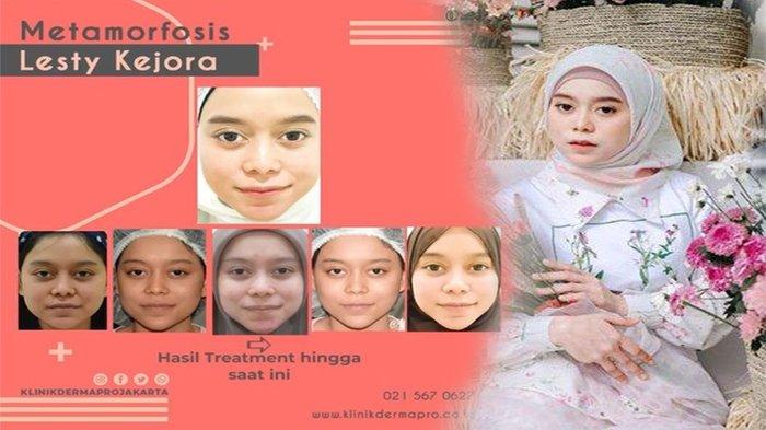 Lesty Kejora Dituding Operasi Plastik, Inul Daratista Bongkar Rahasia