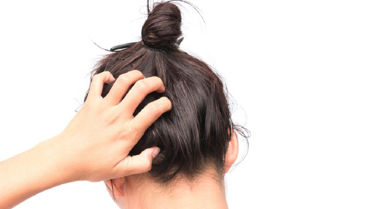 Hair oil dapat mengatasi masalah ketombe di kulit kepala.