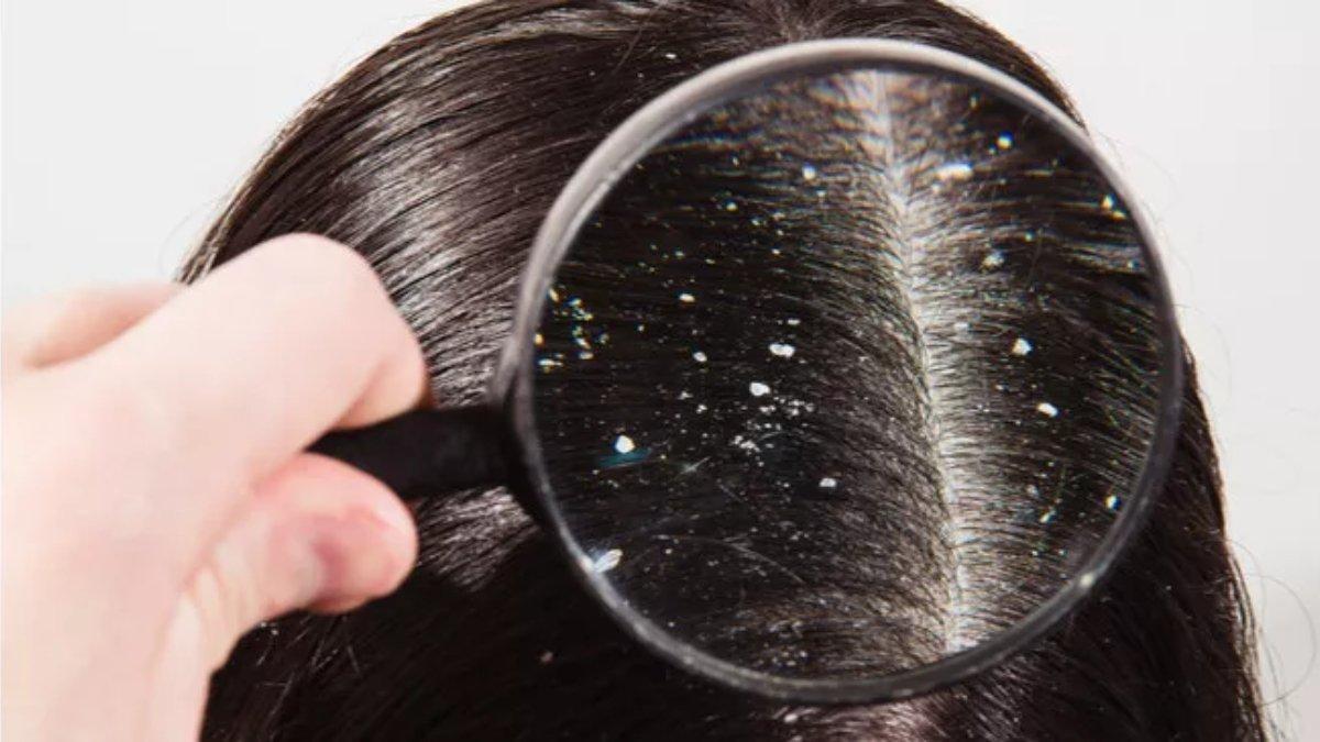 Rambut dengan masalah ketombe.