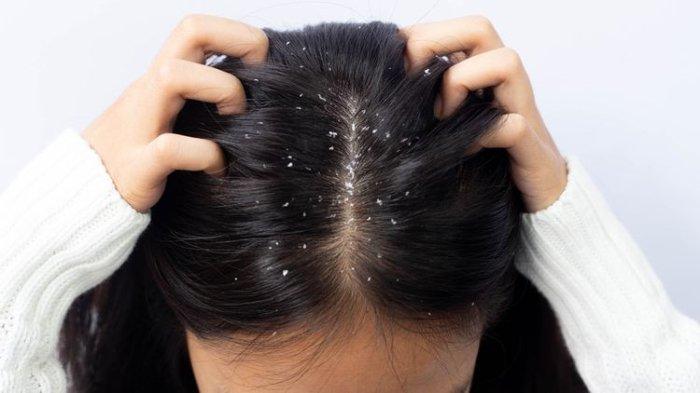 Permasalahan rambut berketombe dapat diatasi dengan mudah menggunakan rempah kayu manis.