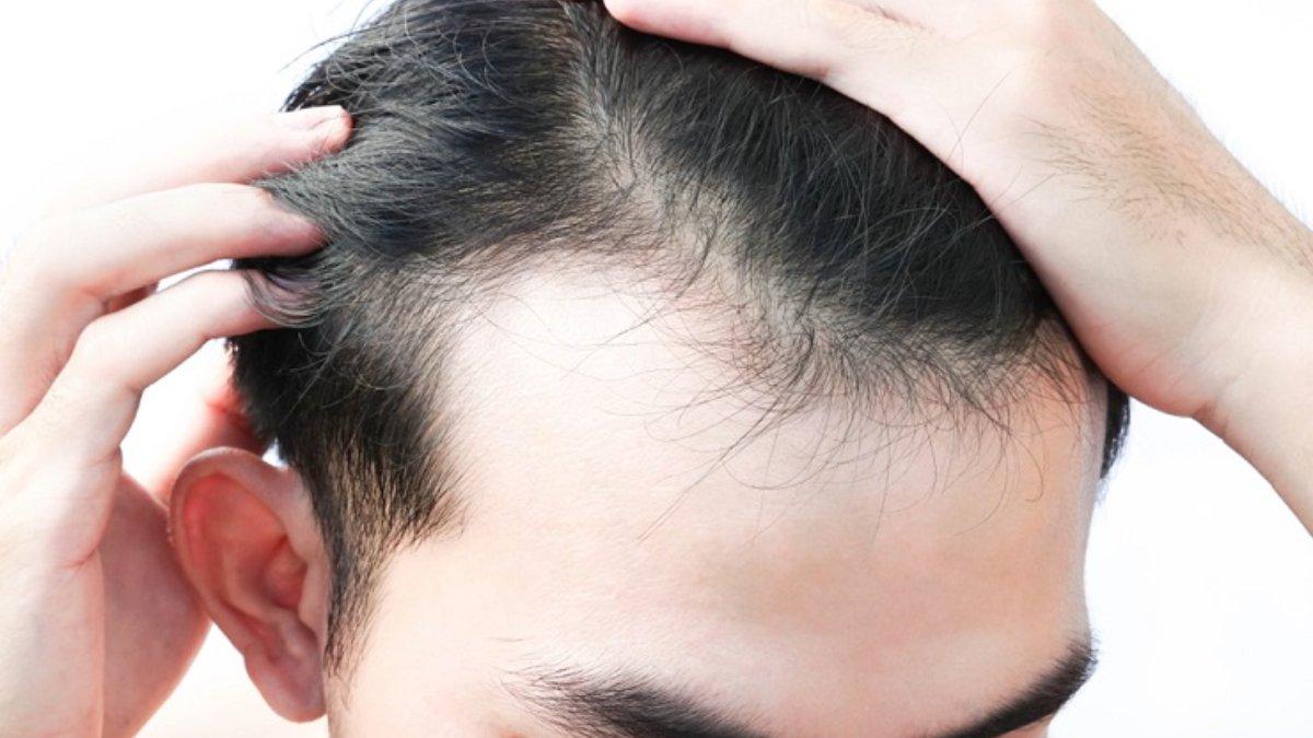 Ilustrasi rambut rontok